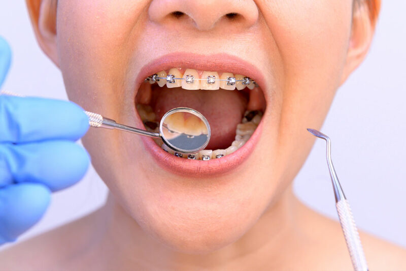 zahnarzt-mit-zahntechnik-mit-frau-die-kieferorthopädische-halterung-zahnpflege-gesunde-zähne-trägt