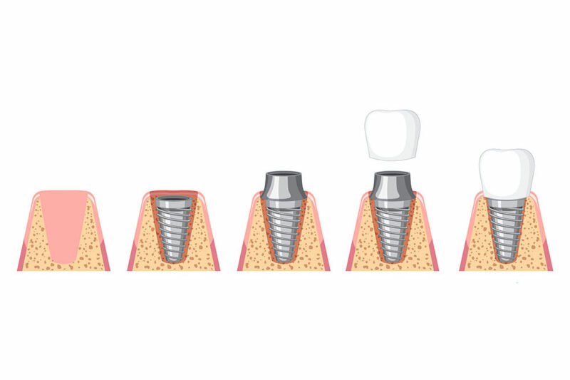 infografik-menschlicher-implantat-installationsprozess
