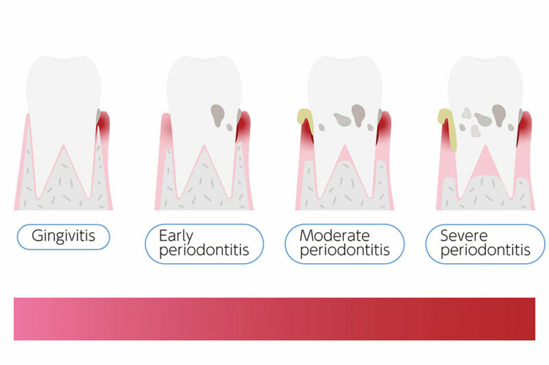 Parodontitis-Ordnung-Fortschritt