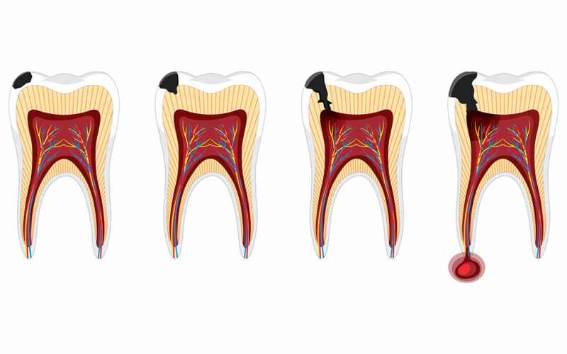 menschliche-stadien-karies